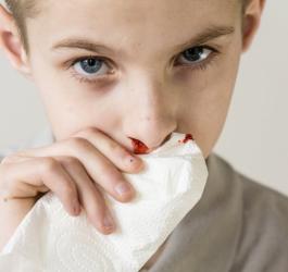 Chłopiec tamuje chusteczką krwotok z nosa