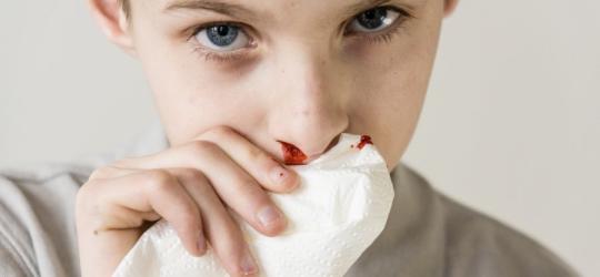 Chłopiec tamuje chusteczką krwotok z nosa