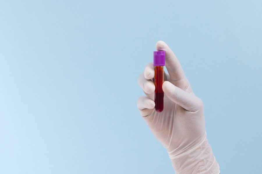 Diagnosta trzyma w dłoni fiolkę z krwią do badania Lipoproteiny (a).