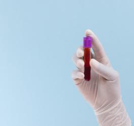 Diagnosta trzyma w dłoni fiolkę z krwią do badania Lipoproteiny (a).