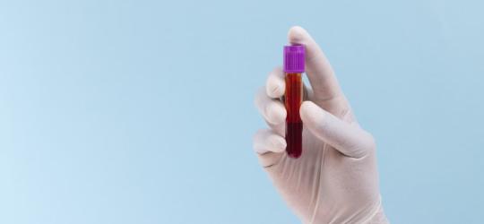 Diagnosta trzyma w dłoni fiolkę z krwią do badania Lipoproteiny (a).