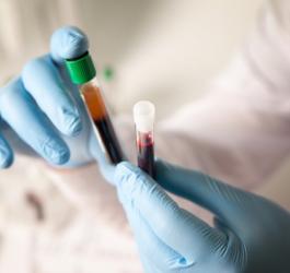 Diagnosta sprawdza próbki krwi pod kątem badania lipoproteiny (A).