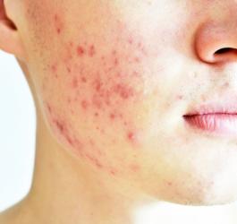 Łojotokowe zapalenie skóry