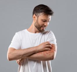 Mężczyzna drapie się po ręce z widocznymi objawami łupieżu Gilberta.