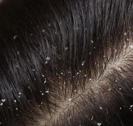 Zbliżenie na włosy z widocznym łupieżem.