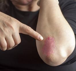 Łuszczyca - jak z nią walczyć?