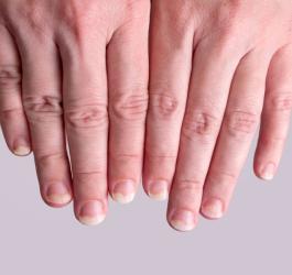 Dłonie z widoczną łuszczycą paznokci.