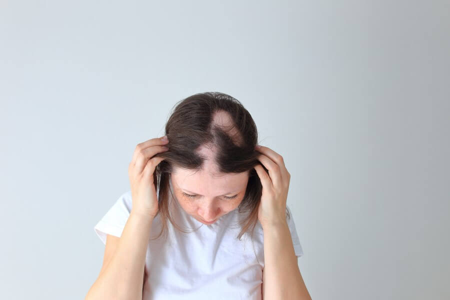 Kobieta pokazuje na głowie objawy łysienia plackowatego.