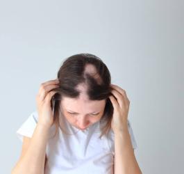 Kobieta pokazuje na głowie objawy łysienia plackowatego.