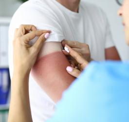 Pielęgniarka nakłada maść na oparzenia na skórę osoby z widocznym oparzeniem słonecznym.