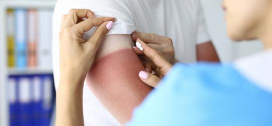 Pielęgniarka nakłada maść na oparzenia na skórę osoby z widocznym oparzeniem słonecznym.