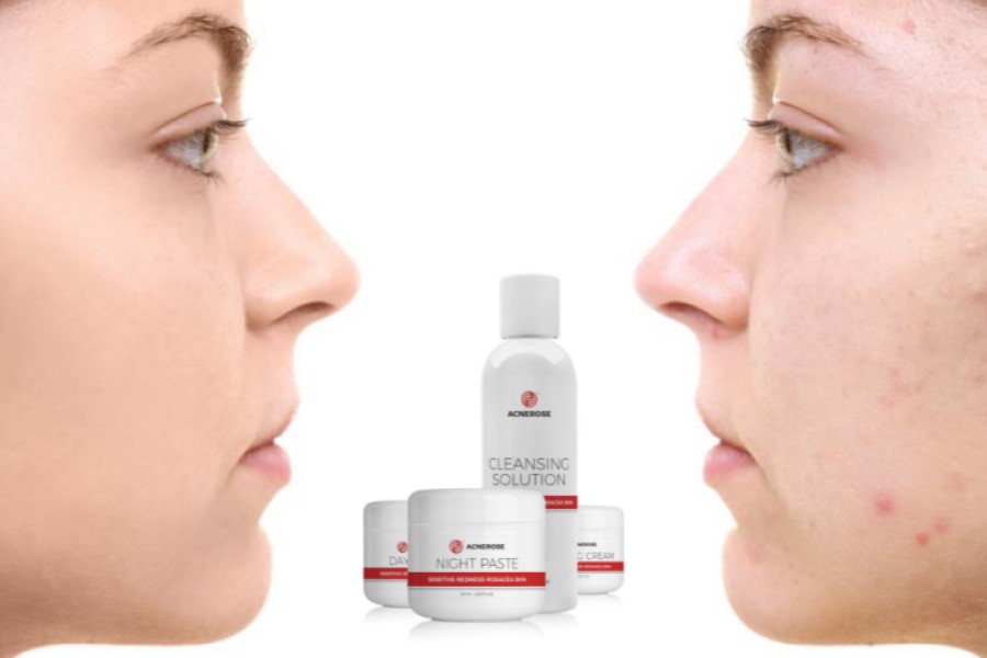 Twarz kobiety przed i po używaniu kosmetyków na trądzik różowaty.