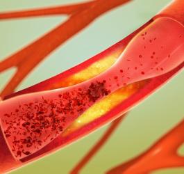 Miażdżyca - rodzaje, objawy