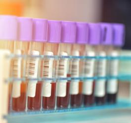 Próbki krwi pacjentów przeznaczone m.in. do badania stężenia mioglobiny.