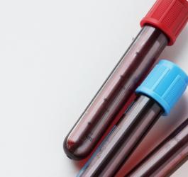 Mocznik we krwi – jakie są normy? 