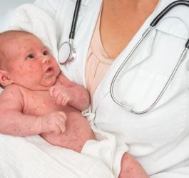 Trzydniówka u niemowląt może być niebezpieczna! Sprawdź, jak dbać o maluszka w czasie choroby