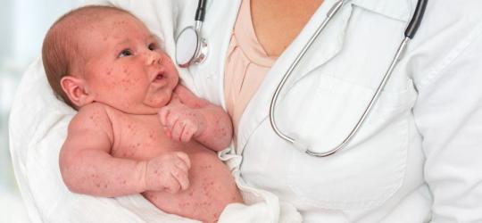 Trzydniówka u niemowląt może być niebezpieczna! Sprawdź, jak dbać o maluszka w czasie choroby