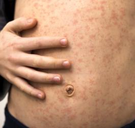 Odra - objawy, leczenie i powikłania