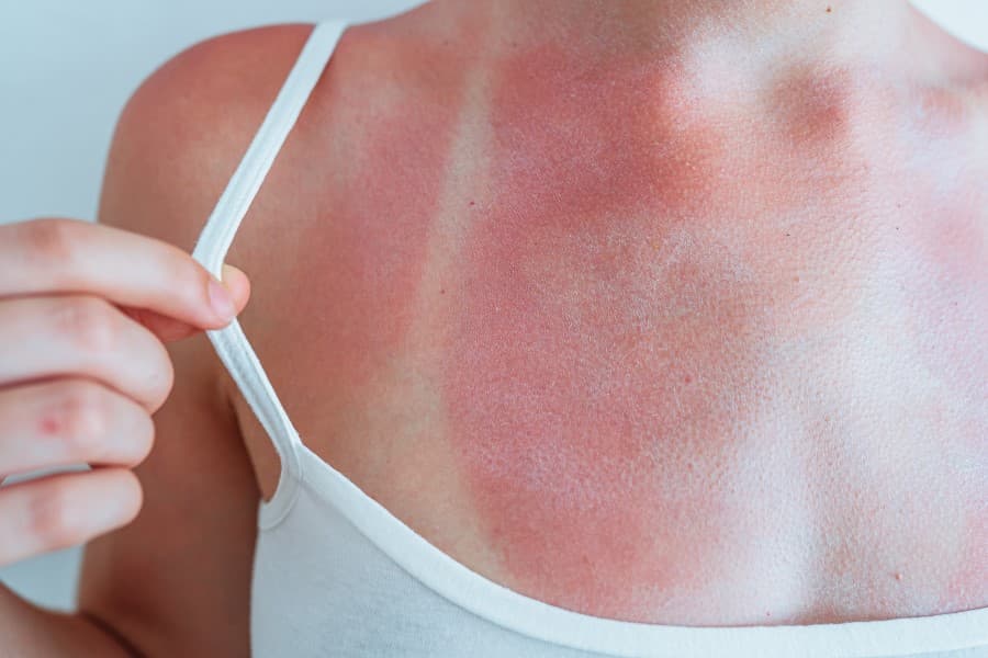 Kobieta pokazuje skórę po oparzeniu słonecznym.