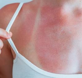 Kobieta pokazuje skórę po oparzeniu słonecznym.