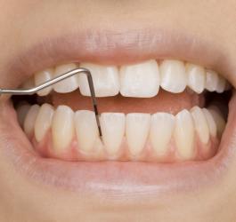 Zęby pacjenta podczas badania zgłębnikiem.