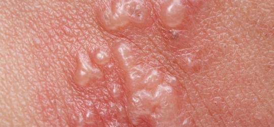 Pęcherze na zaczerwienionej skórze to objaw pęcherzycy - choroby o podłożu autoimmunologicznym.