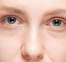 Podkrążone oczy - więcej niż problem estetyczny