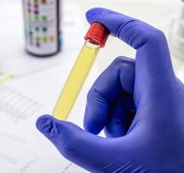 Próbka moczu zebranego do posiewu moczu.