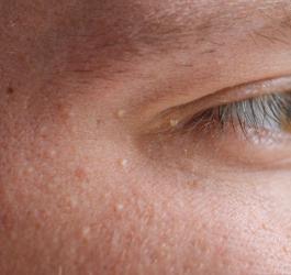 Prosaki – czym są?