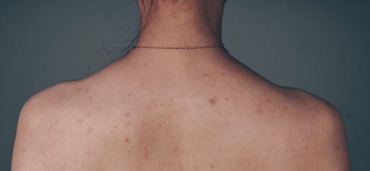 Pryszcze na plecach - jak się ich pozbyć?