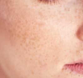 Zbliżenie na twarz kobiety z widocznymi przebarwieniami na twarzy.