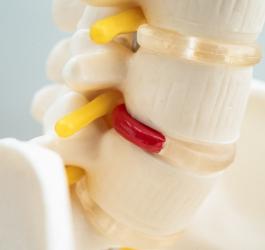 Widoczna na modelu przepuklina kręgosłupa.