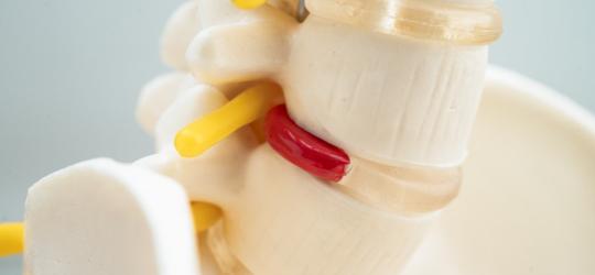 Widoczna na modelu przepuklina kręgosłupa.