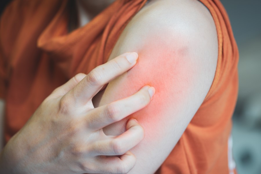 Objawy skórne róży na ramieniu kobiety.