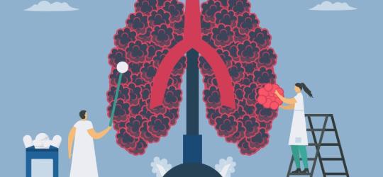 Grafika 2D ludzkich płuc z objawami rozedmy płuc.