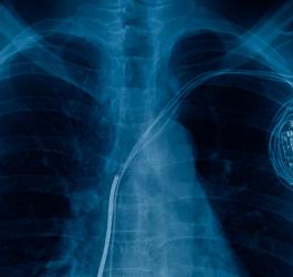 Widoczny na RTG rozrusznik serca.