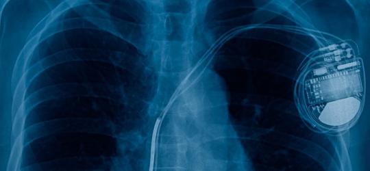 Widoczny na RTG rozrusznik serca.