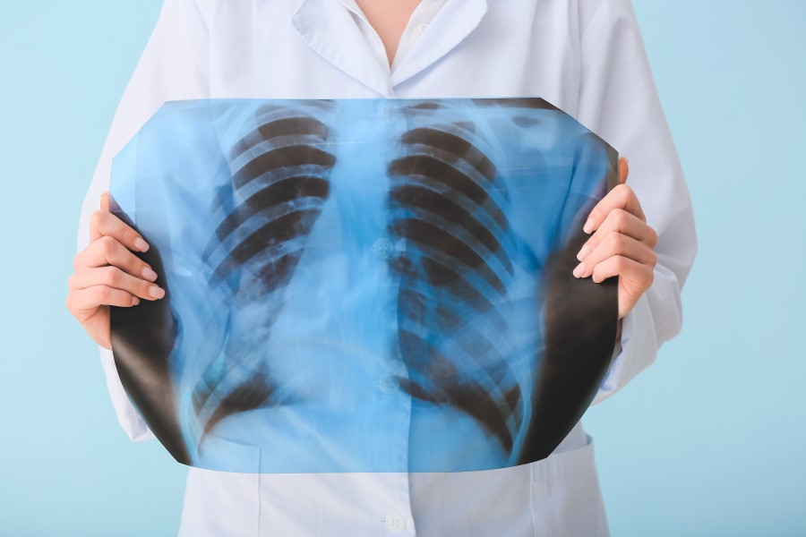 Pracownik medyczny trzyma w rękach zdjęcie RTG klatki piersiowej.