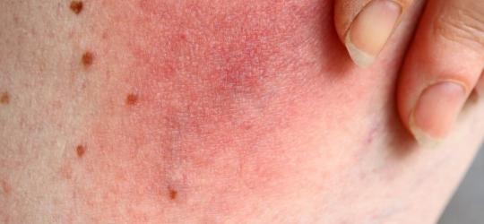 Rumień wędrujący na powierzchni skóry.