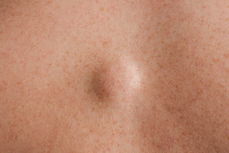 Tłuszczak widoczny na powierzchni skóry.