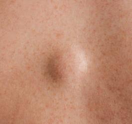 Tłuszczak widoczny na powierzchni skóry.