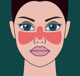 Toczeń rumieniowaty - przyczyny, objawy, leczenie