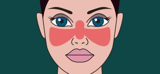 Toczeń rumieniowaty - przyczyny, objawy, leczenie