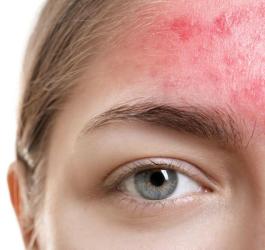 trądzik hormonalny dziewczyna