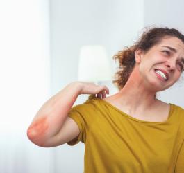 Kobieta drapie się po mocno zaczerwienionej skórze, zaognionej z powodu uczulenia na słońce.