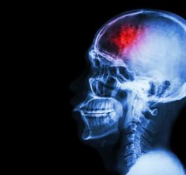 Udar niedokrwienny mózgu - przyczyny, diagnostyka i leczenie KtoMaLek.pl