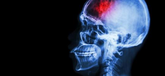 Udar niedokrwienny mózgu - przyczyny, diagnostyka i leczenie KtoMaLek.pl
