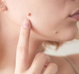 Zbliżenie na policzek młodej kobiety, która palcem wskazuje na istniejące znamię skórne.