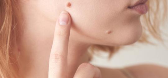 Zbliżenie na policzek młodej kobiety, która palcem wskazuje na istniejące znamię skórne.