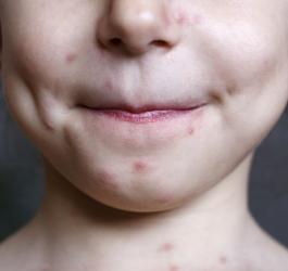 W jaki sposób objawia się ospa?